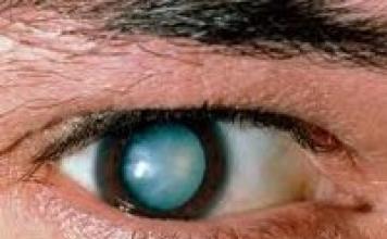 Что такое катаракта: причины, симптомы, лечение народными средствами