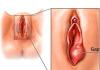 Женские гинекологические болезни: причины, симптомы, лечение
